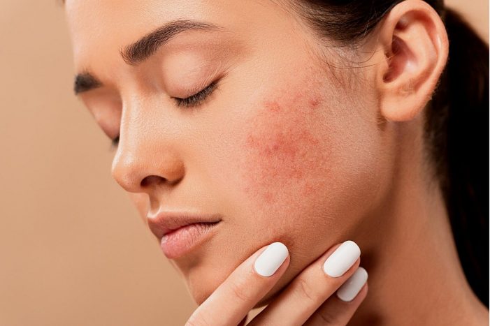 Skin care e Cannabis, un naturale connubio per la salute della pelle